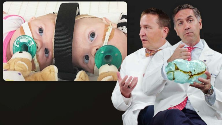 Surgeons Break Down Separating Conjoined Twins
