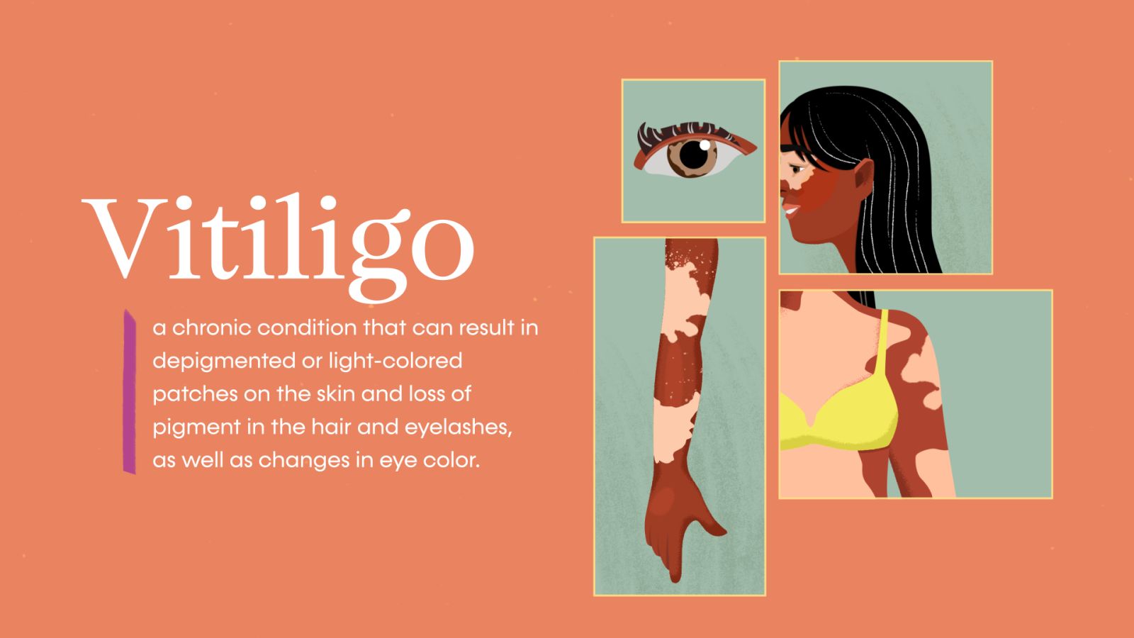 What is Vitiligo?
