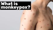 Epidemiologist Answers Common Monkeypox Questions