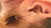 A Cockroach Stuck in Your Ear? | How Common Is It?