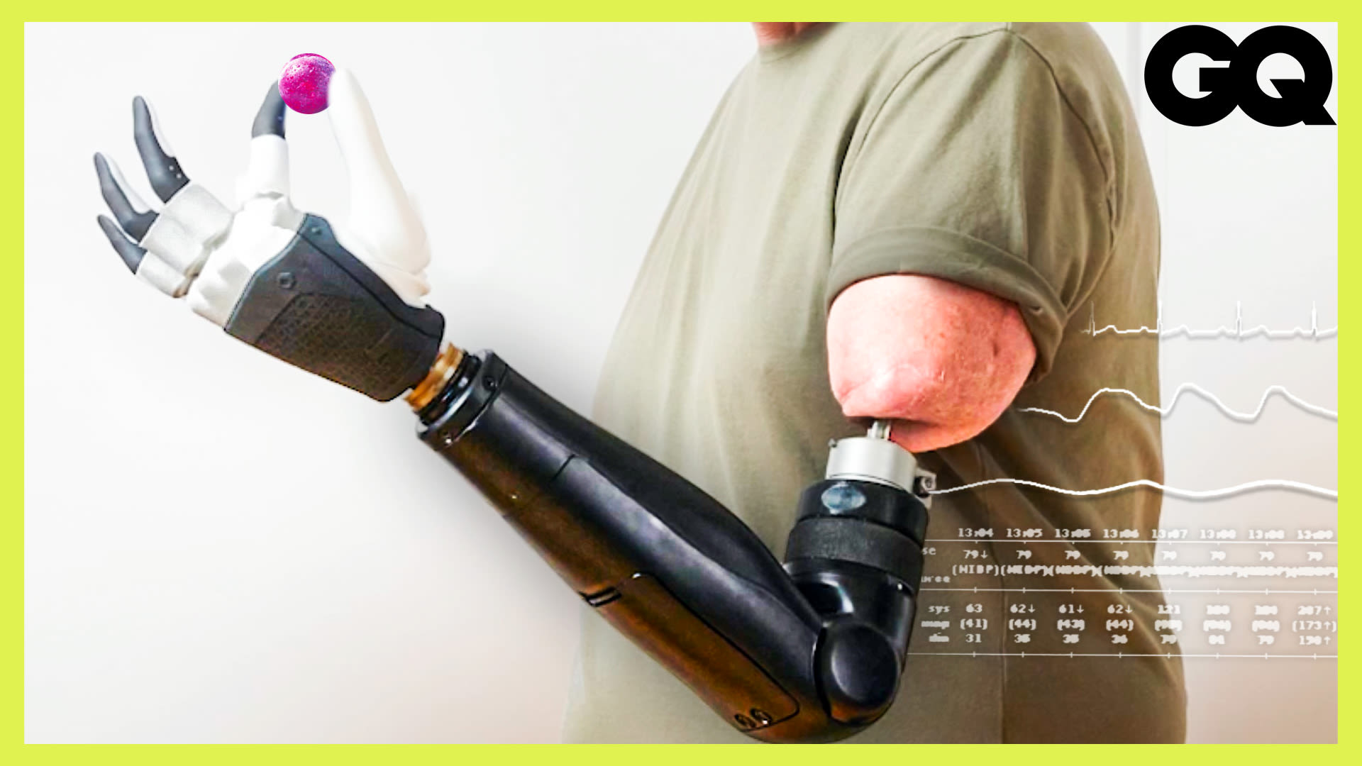 Revolutionizing Prosthetics: A Breakthrough in Bionic Limb Design ...