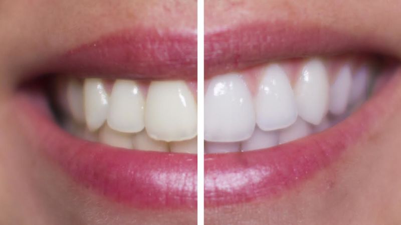 DIY Teeth Whitening VS Professional - BuzzFeed Videos - The Scene
